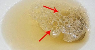 Đi ngoài ra bọt là bệnh lý gì? Có nguy hiểm không?